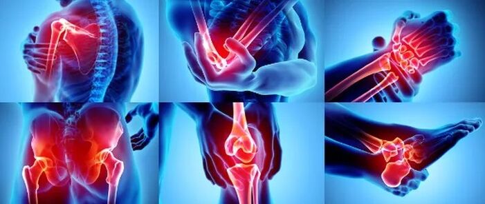 HondroFrost stellt betroffene Gelenke wieder her